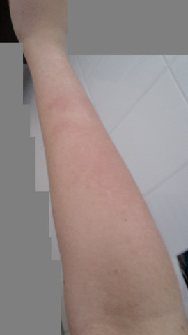 Arm nach Sonneneinfluss - (Haut, Knie, Durchblutung)