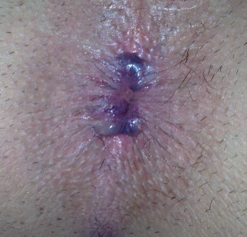 von heute - (After, Hämorrhoiden, Analthrombose)