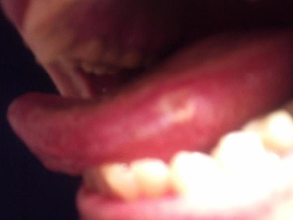 Aphten auf der Zunge + Entzündung im Gesicht