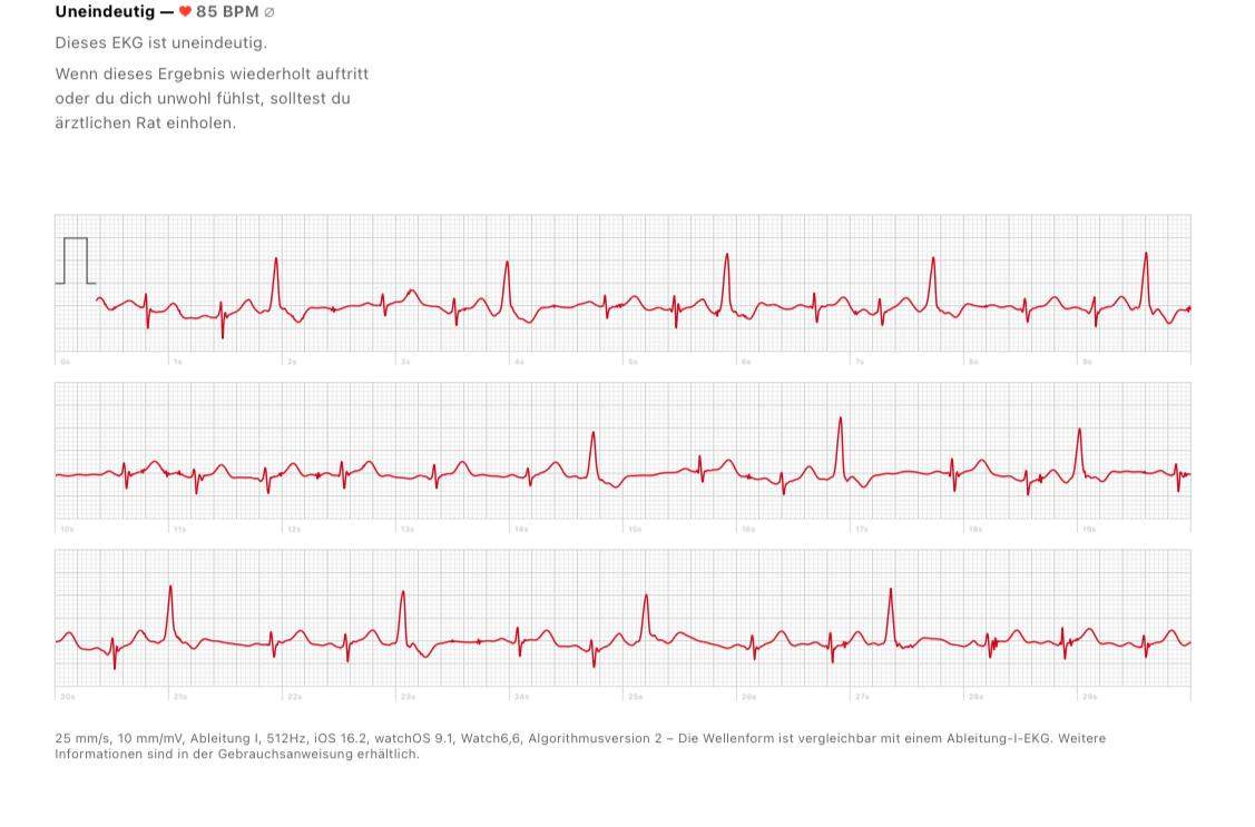 Auffälliges EKG anhand AppleWatch? (EKG-Auswertung)