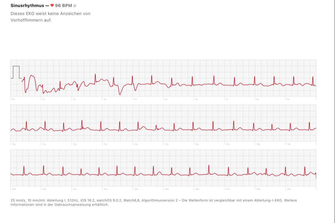 Wie Sieht Ein Auffälliges Ekg Aus