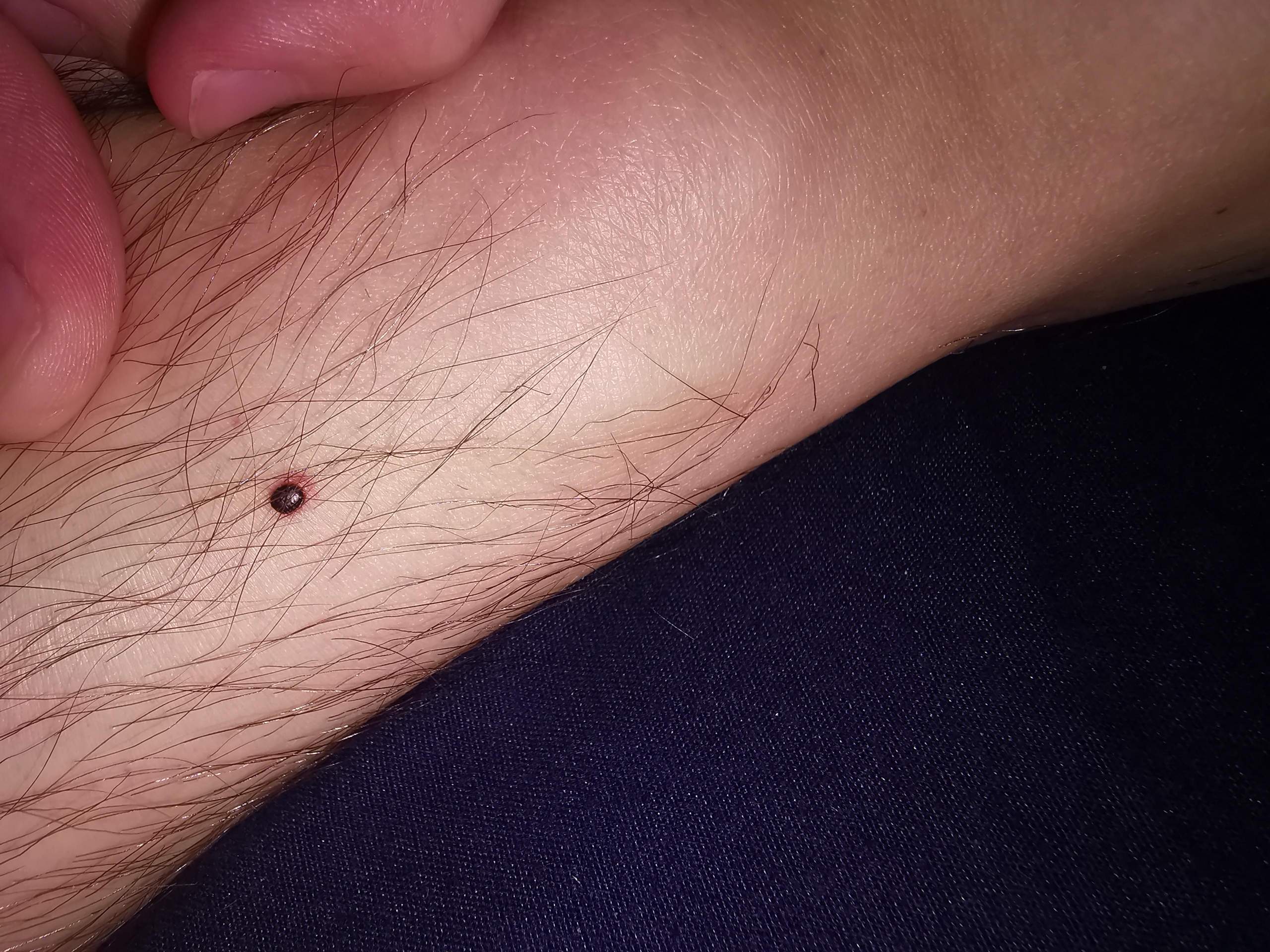 Auffälliges Muttermal mit rotem Rand?