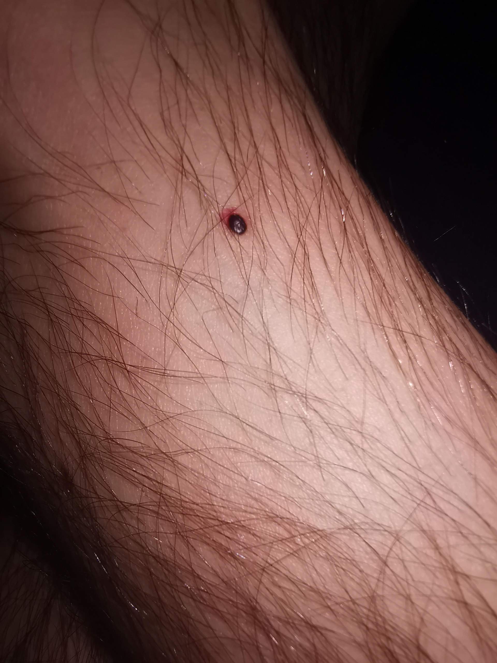 Auffälliges Muttermal mit rotem Rand?