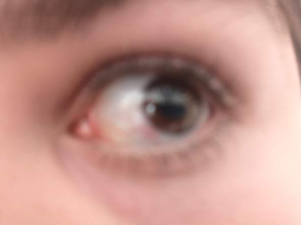 - (Augen, Gesundheit)