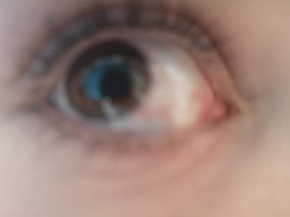 - (Augen, Gesundheit)