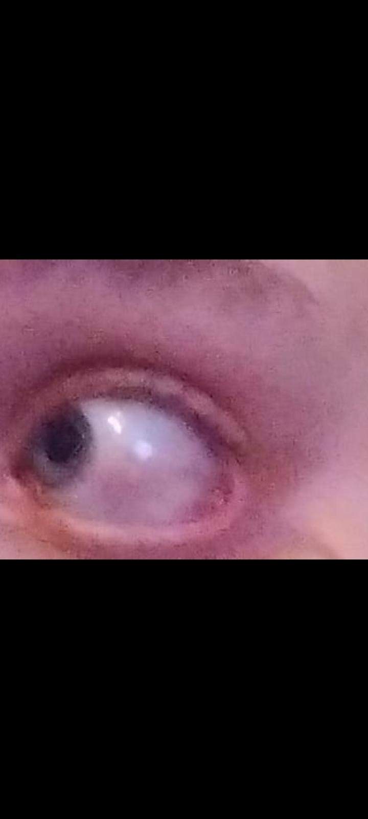 Auge tut weh und blutet ein? (Schmerzen, Augen, Blut)