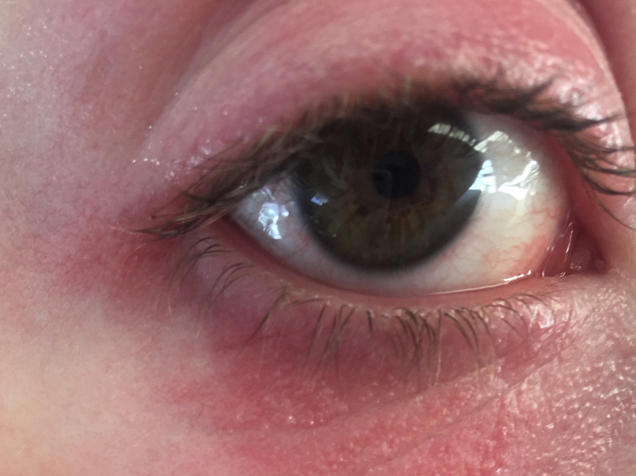 Augenentzündung was könnte es sein? (Entzündung)