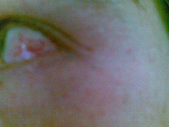 Angst vor Augenherpes - (Medikamente, Augen, Augenherpes)