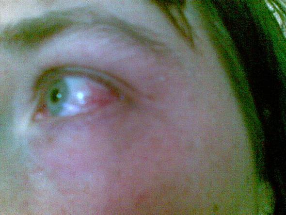 Augenherpes Nach Gurtelrose Medikamente Augen Augenherpes Nach Gurtelrose Medikamente Augen