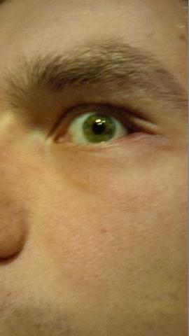Auge - (Entzündung, Juckreiz, Augenlid)