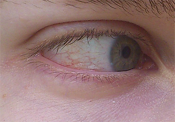 Rote Adern - (Augenheilkunde, Augentropfen, Trockene Augen)