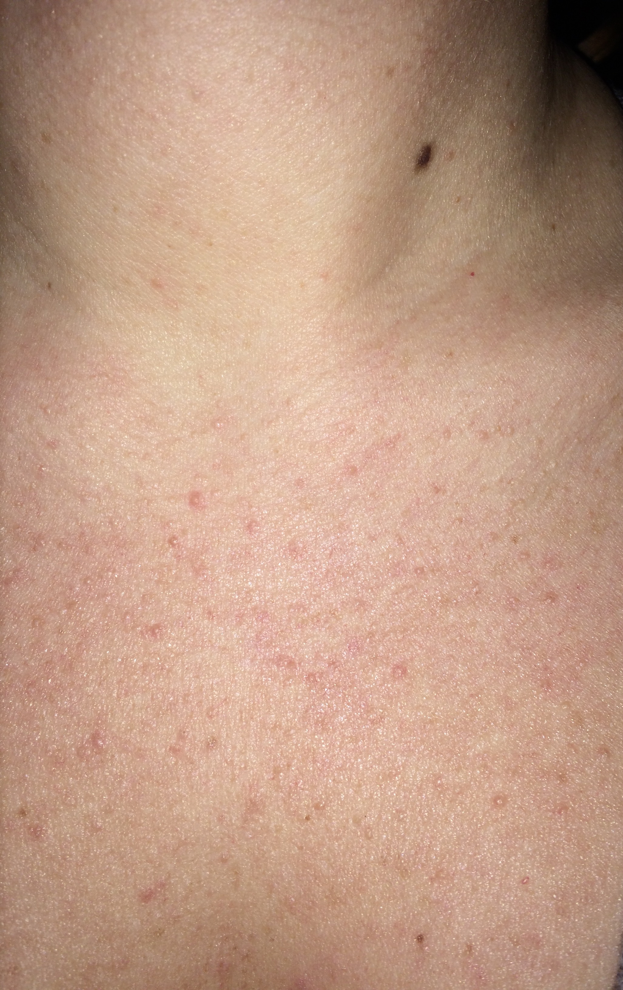 50+ Kleine Pickel Im Mundbereich Images