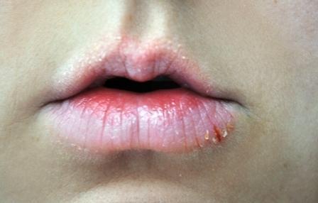 Ausgefranste Lippen und braune Mundpartie