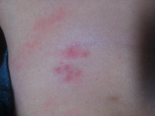 Auschlag Am Bauch Auschlag Am Bauch