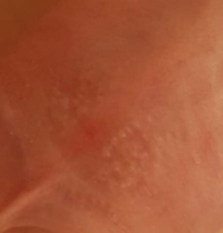 Ausschlag Auf Der Vorhaut Haut Penis Ausschlag Auf Der Vorhaut Haut Penis