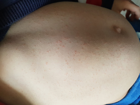 Ausschlag Der Immer Wieder Kommt Kinder Angst Pickel Ausschlag Der Immer Wieder Kommt Kinder Angst Pickel