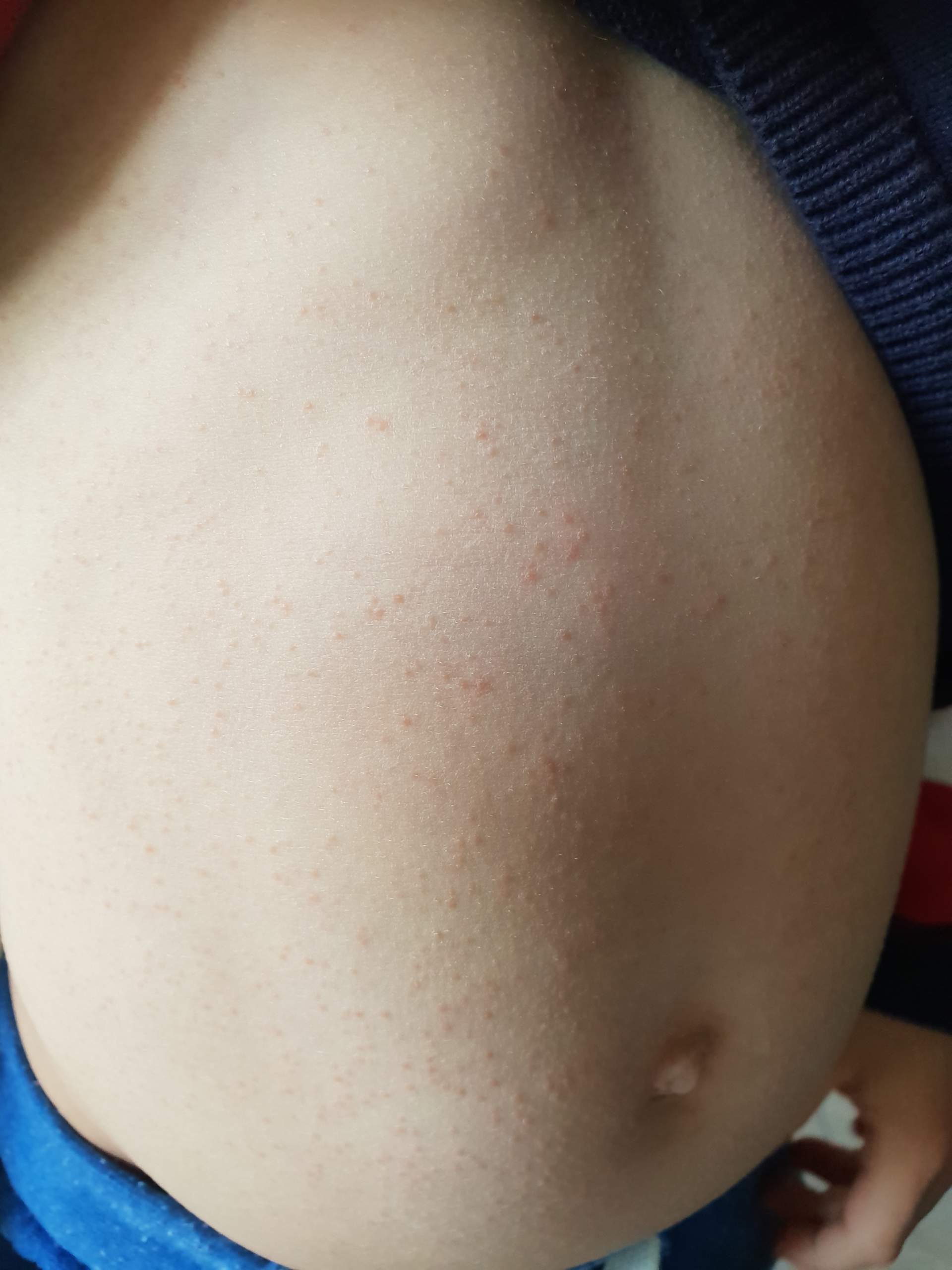 Ausschlag der immer wieder kommt? (Kinder, Angst, Pickel)