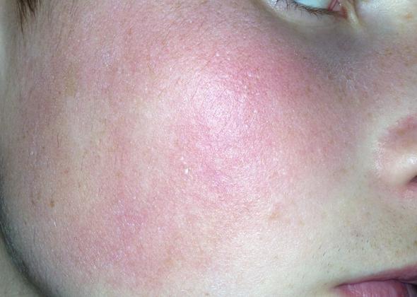 heat rash photo #10