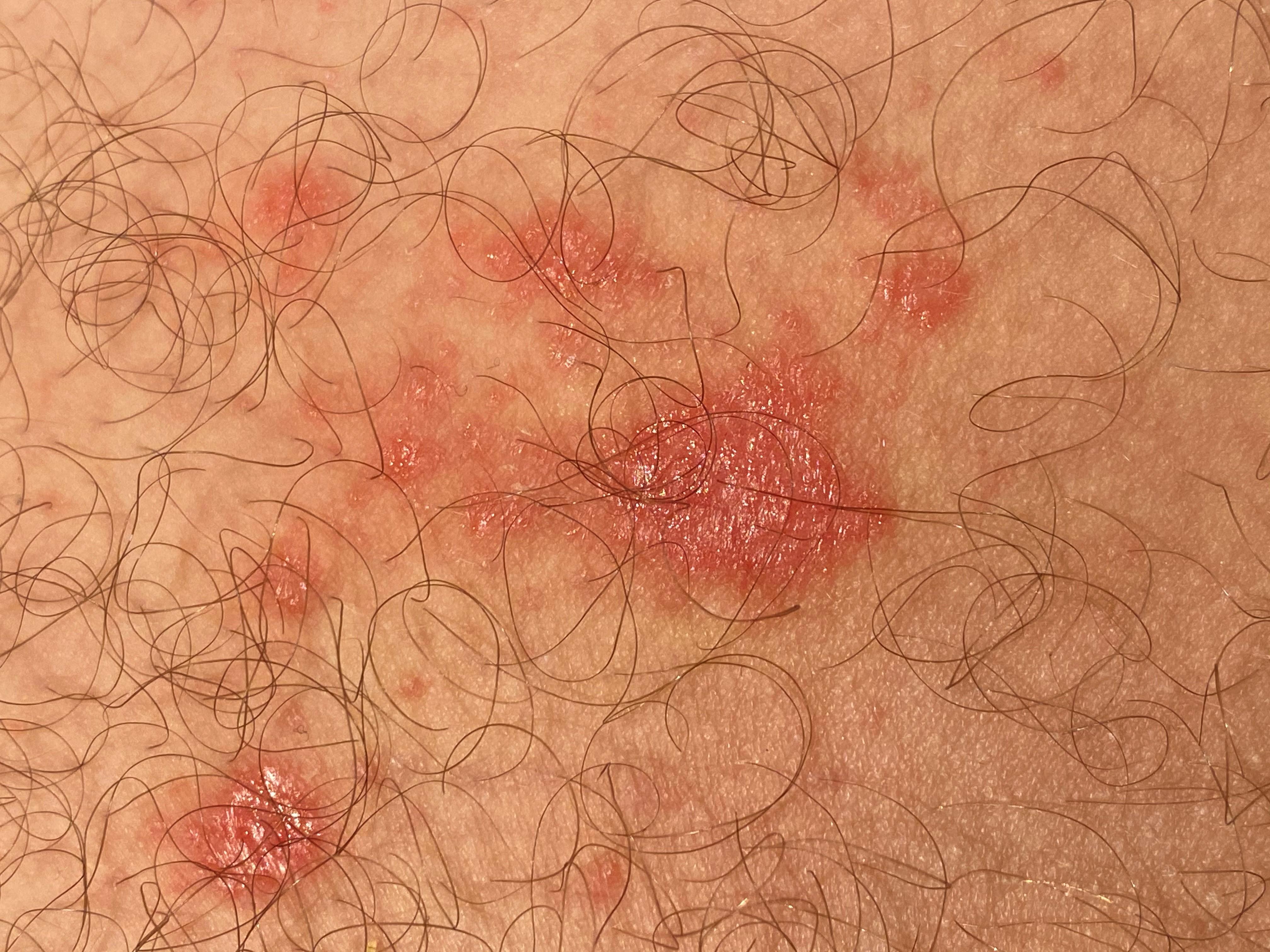 Ausschlag rechts und links des Hoden, Oberschenkelinnenseite? (Haut, Oberschenkel)