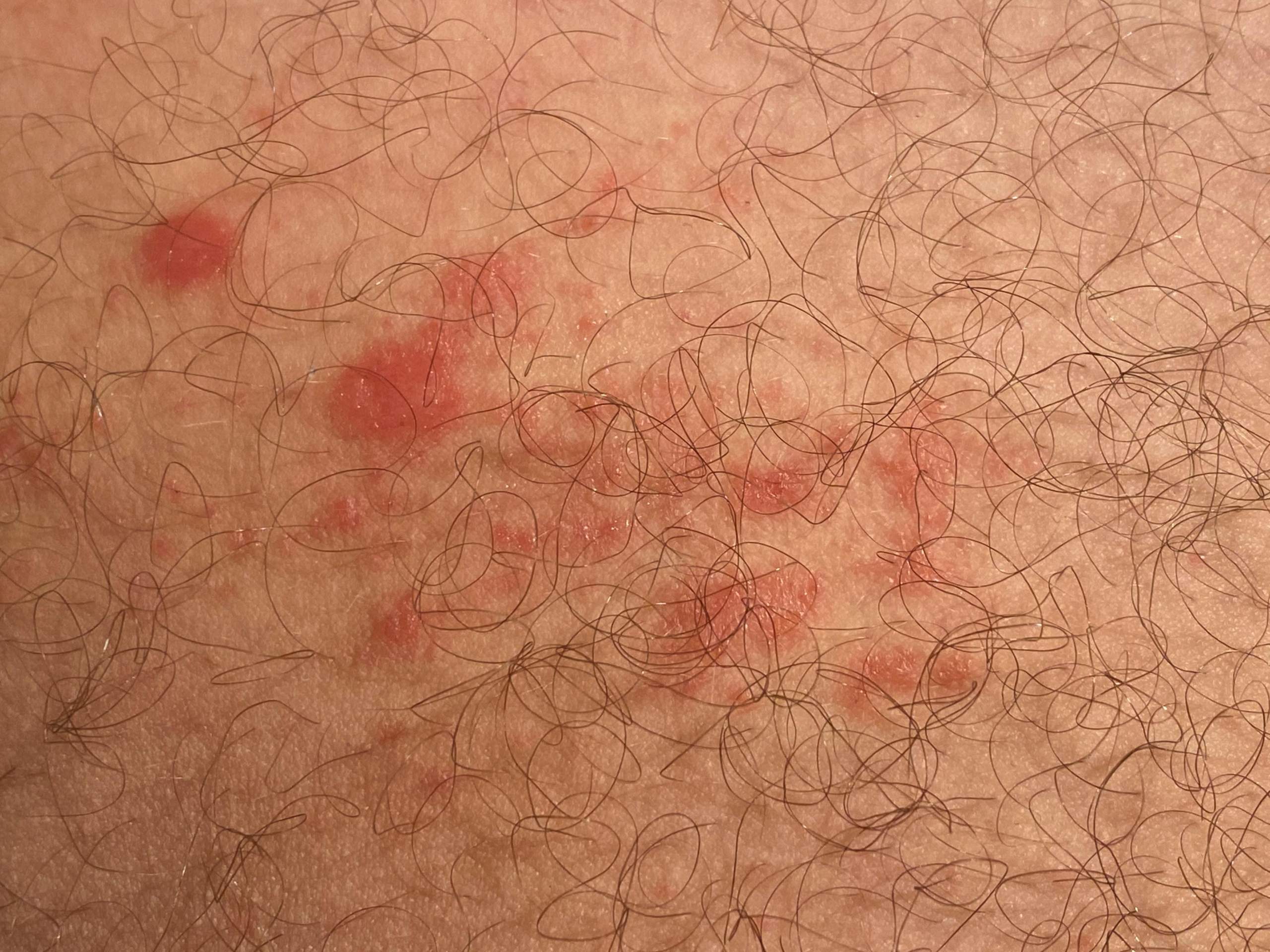 Ausschlag rechts und links des Hoden, Oberschenkelinnenseite? (Haut, Oberschenkel)