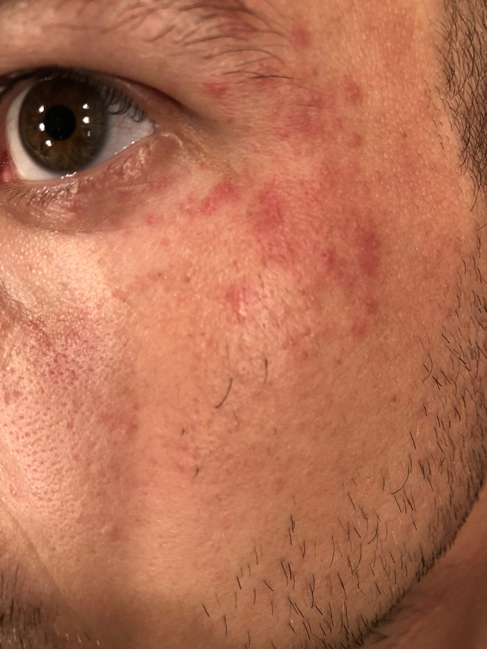 Ausschlag/Ekzem an beiden Augen?