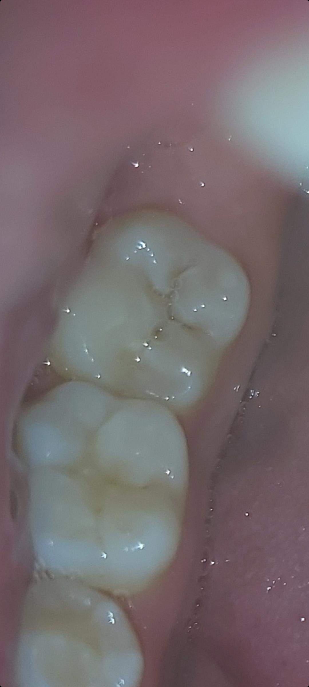 Backenzahn schmerzt beim Zubeißen? (Schmerzen, Zähne, Zahnarzt)