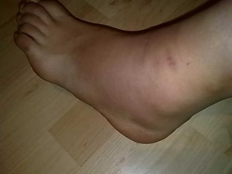 Banderriss Im Linken Osg Fusse Schwellung Knochen Banderriss Im Linken Osg Fusse Schwellung Knochen