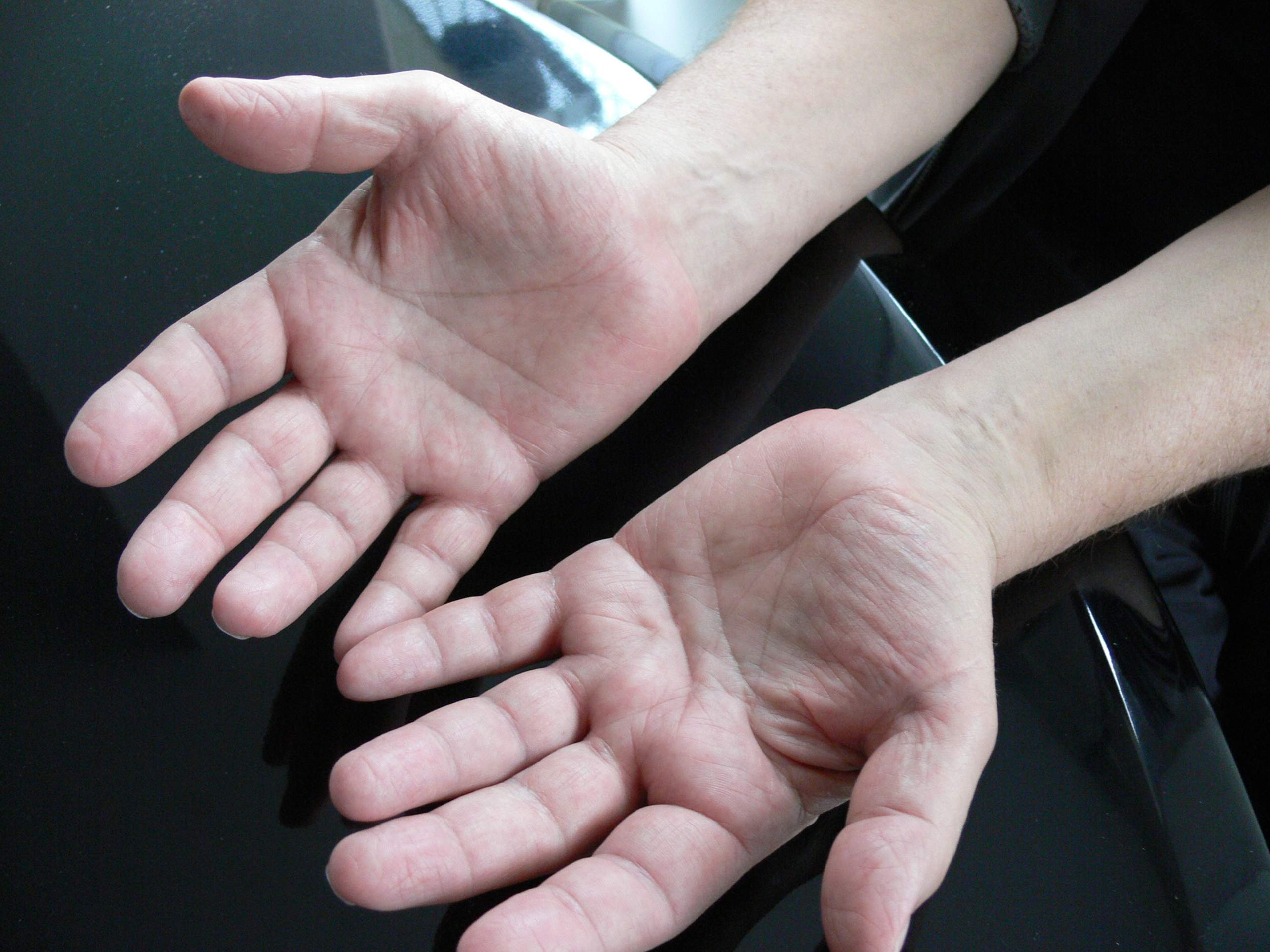 Beide Hände und alle Finger seit September 2013 stark und schmerzhaft