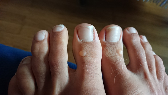 Beide Zehen Warze oder was anderes?? (Haut, Warzen)