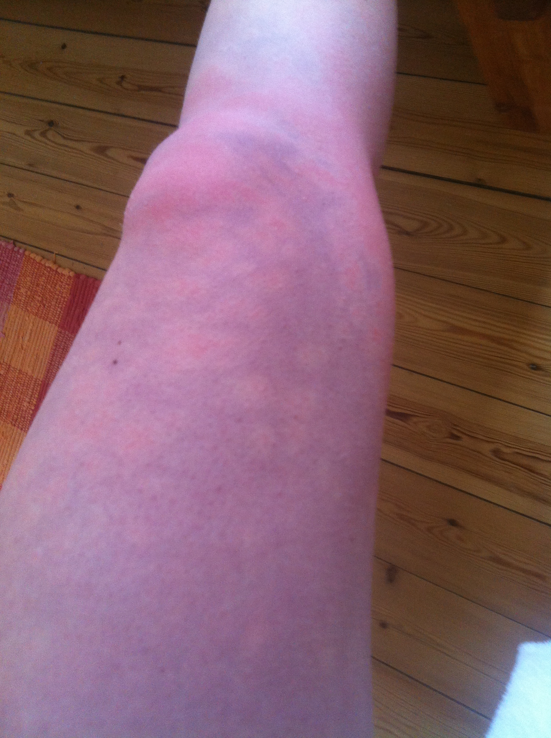 Beine nach langem stehen rotblau verfärbt...was ist das? (Haut, Knie, Durchblutung)