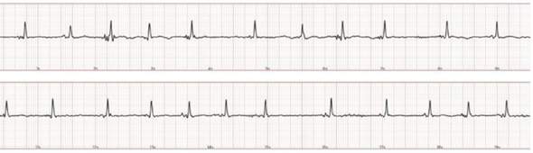 Benötige Hilfe bei einer EKG-Auswertung (siehe Anhang) --> Unregelmäßigkeit?