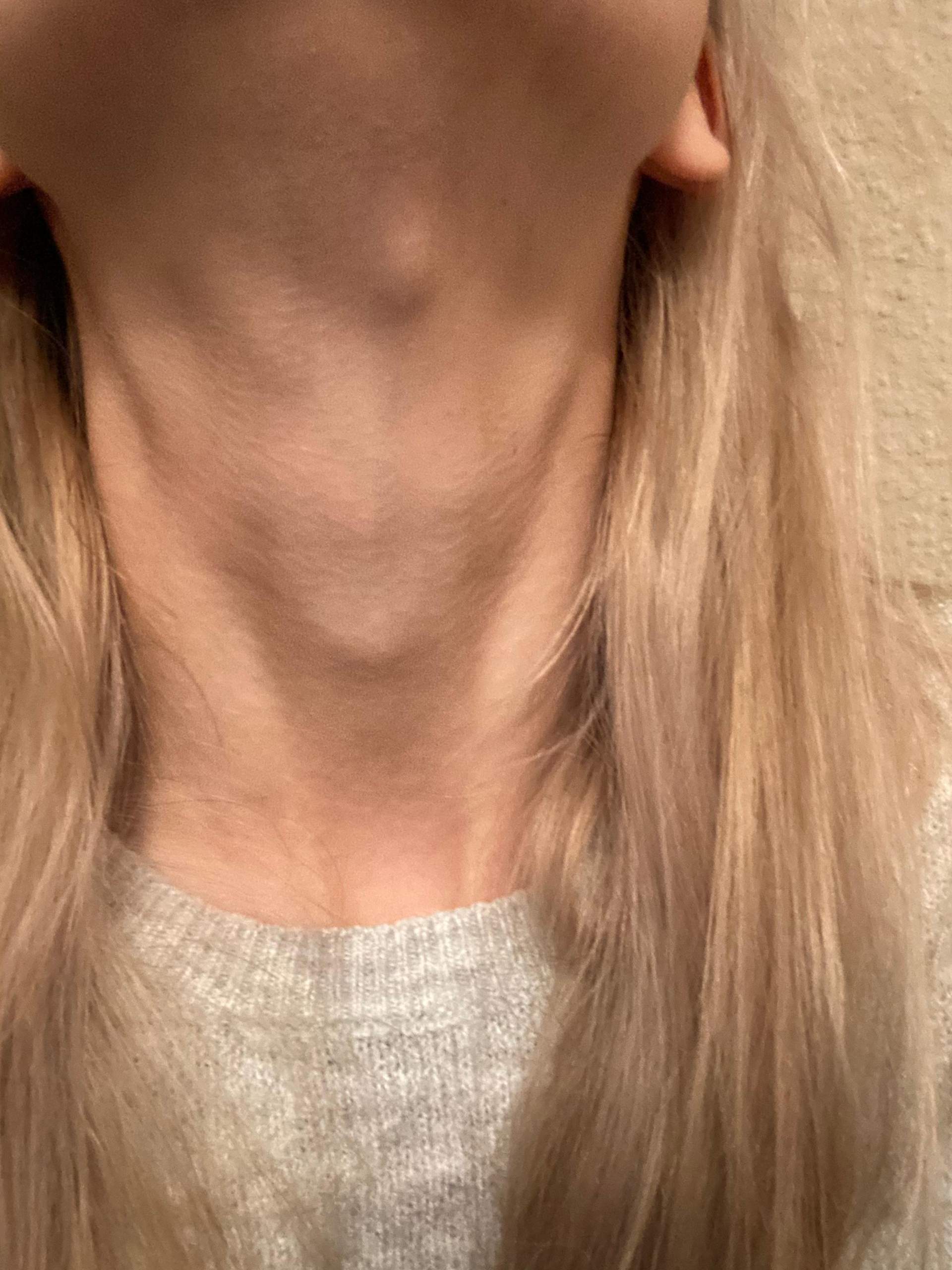 Beule am Hals , ist es nur eine Anschwellung des Lymphknotens? (Haut)