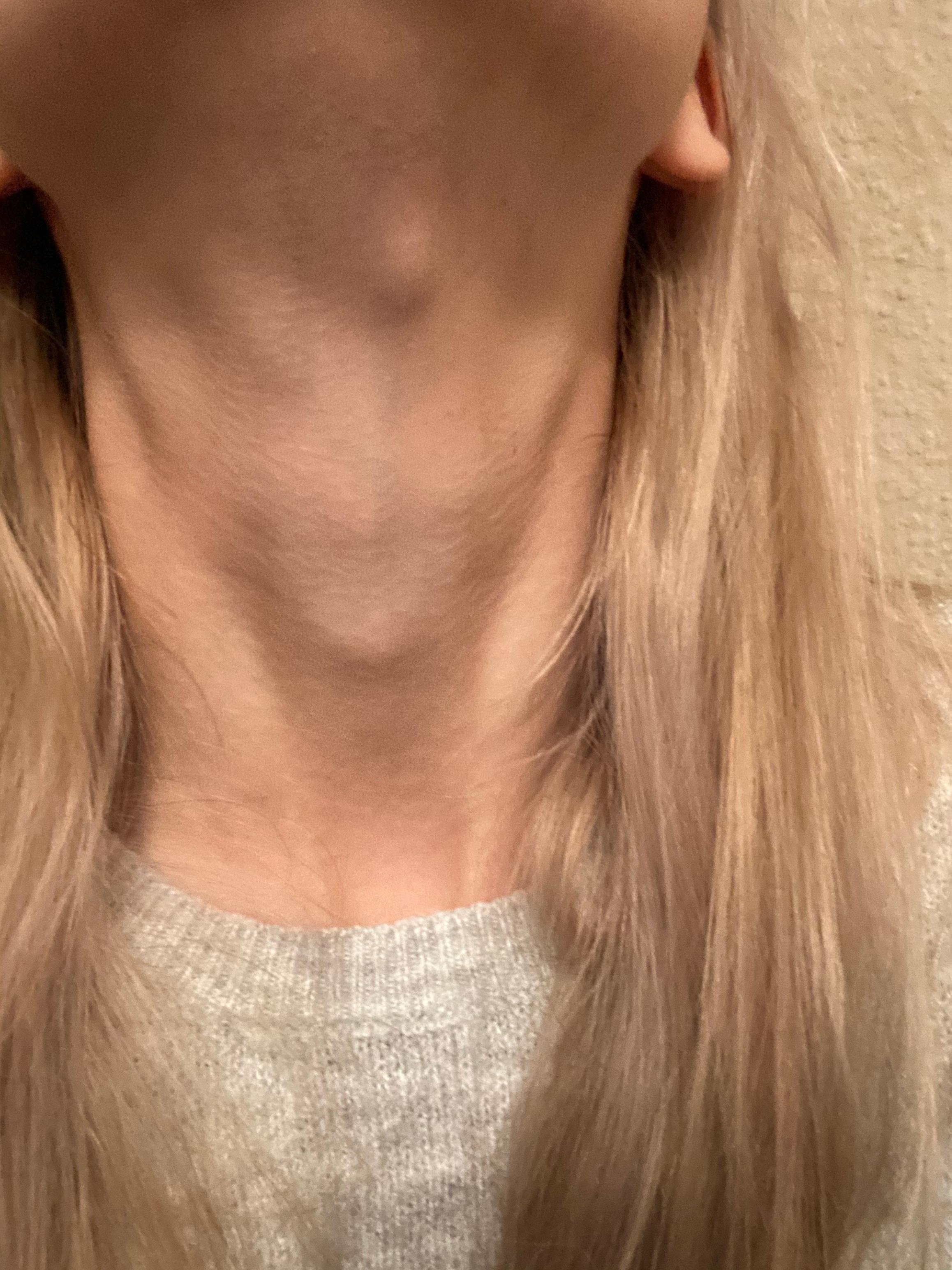 50++ Kropf am hals bilder , Beule am Hals , ist es nur eine Anschwellung des Lymphknotens? (Haut)