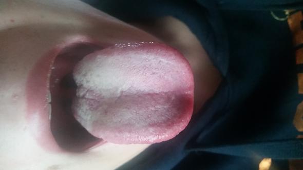 meine zunge normal - (Zunge, krank)