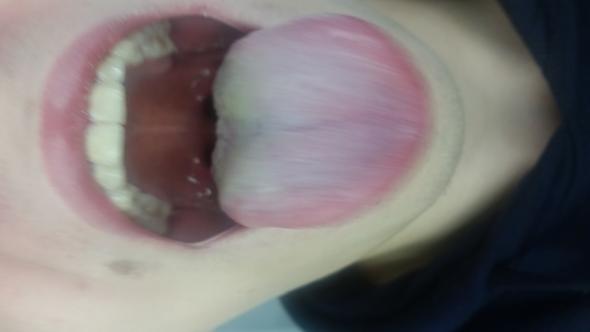 meine zunge normal 2 - (Zunge, krank)