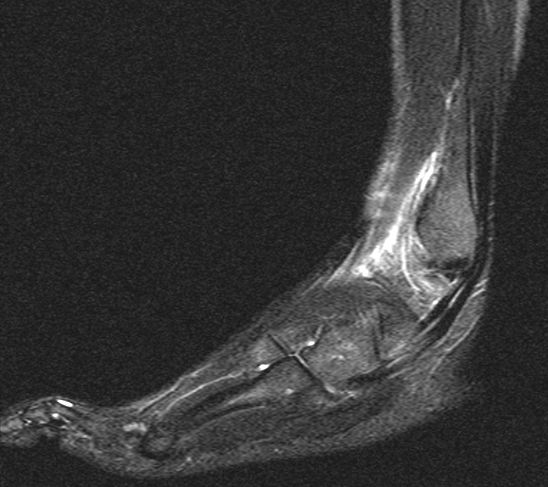 Aussenband Riss oberes Sprunggelenk: Wer kann mir helfen? (Füße