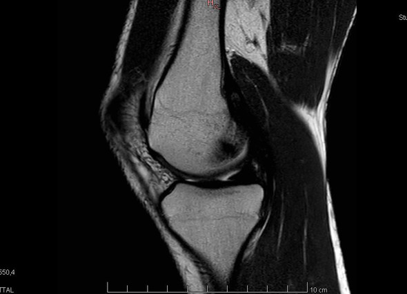 Bitte um Hilfe MRT Knie, kann das ein Tumor sein?