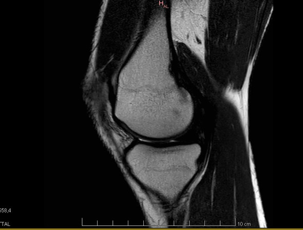 43+ Tumor im knie bilder , Bitte um Hilfe MRT Knie, kann das ein Tumor sein?