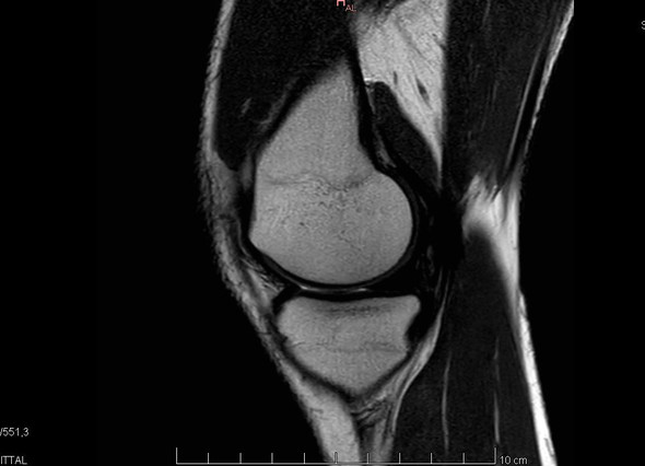 Bitte um Hilfe MRT Knie, kann das ein Tumor sein?