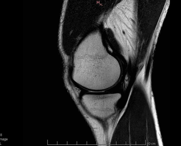 50+ Tumor im knie bilder , Bitte um Hilfe MRT Knie, kann das ein Tumor sein?