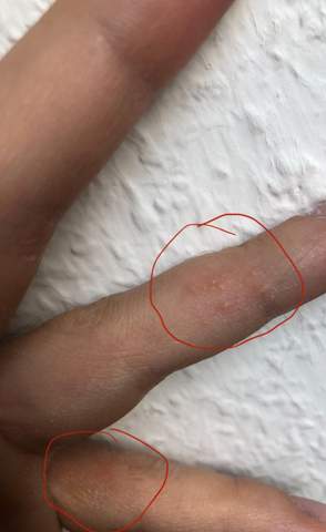 Bläschen am Finger = Pflasterallergie?