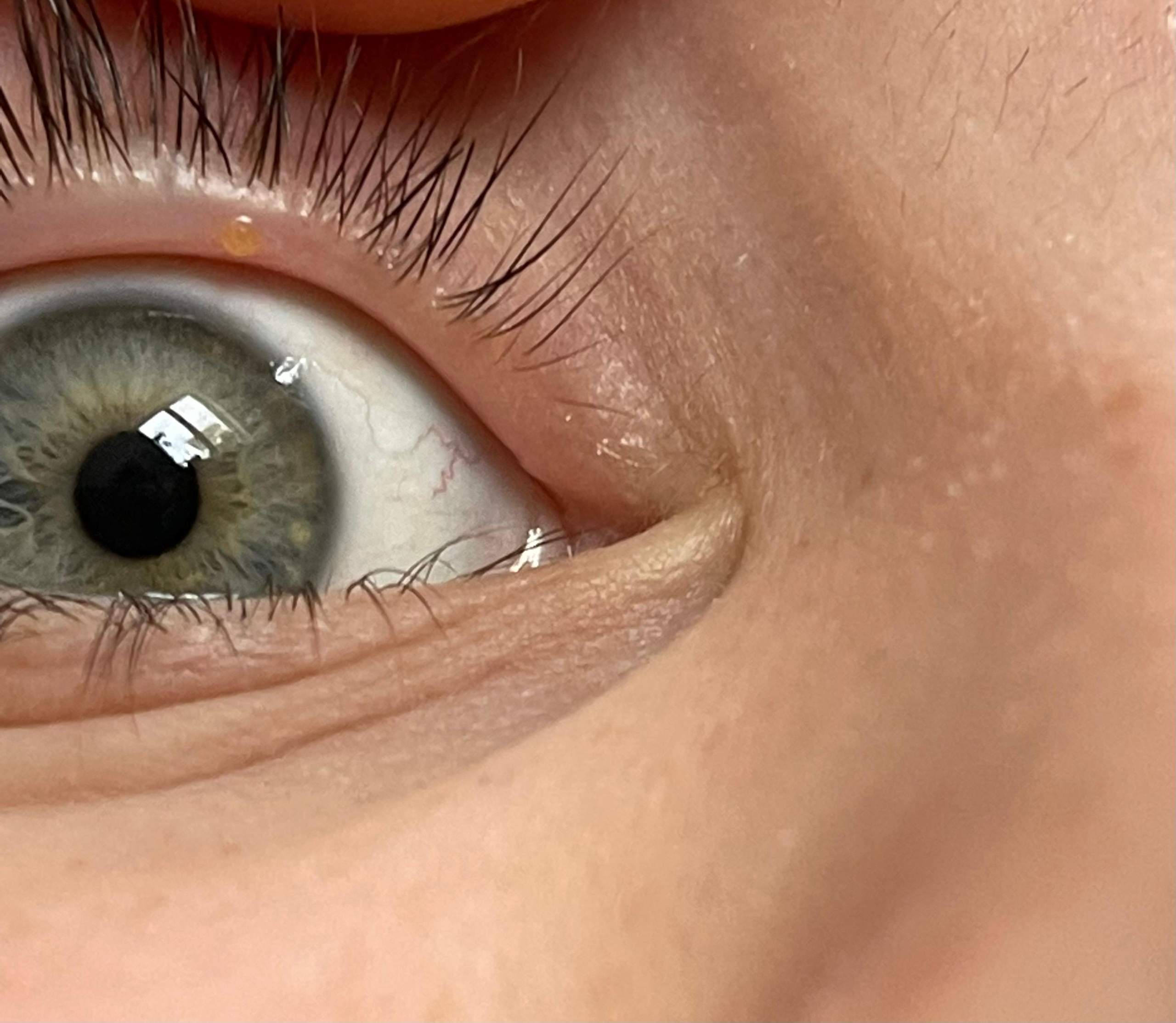 Wasserblase Im Auge Was Tun