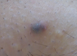 28+ Schwarze Flecken Nach Pickel Pictures