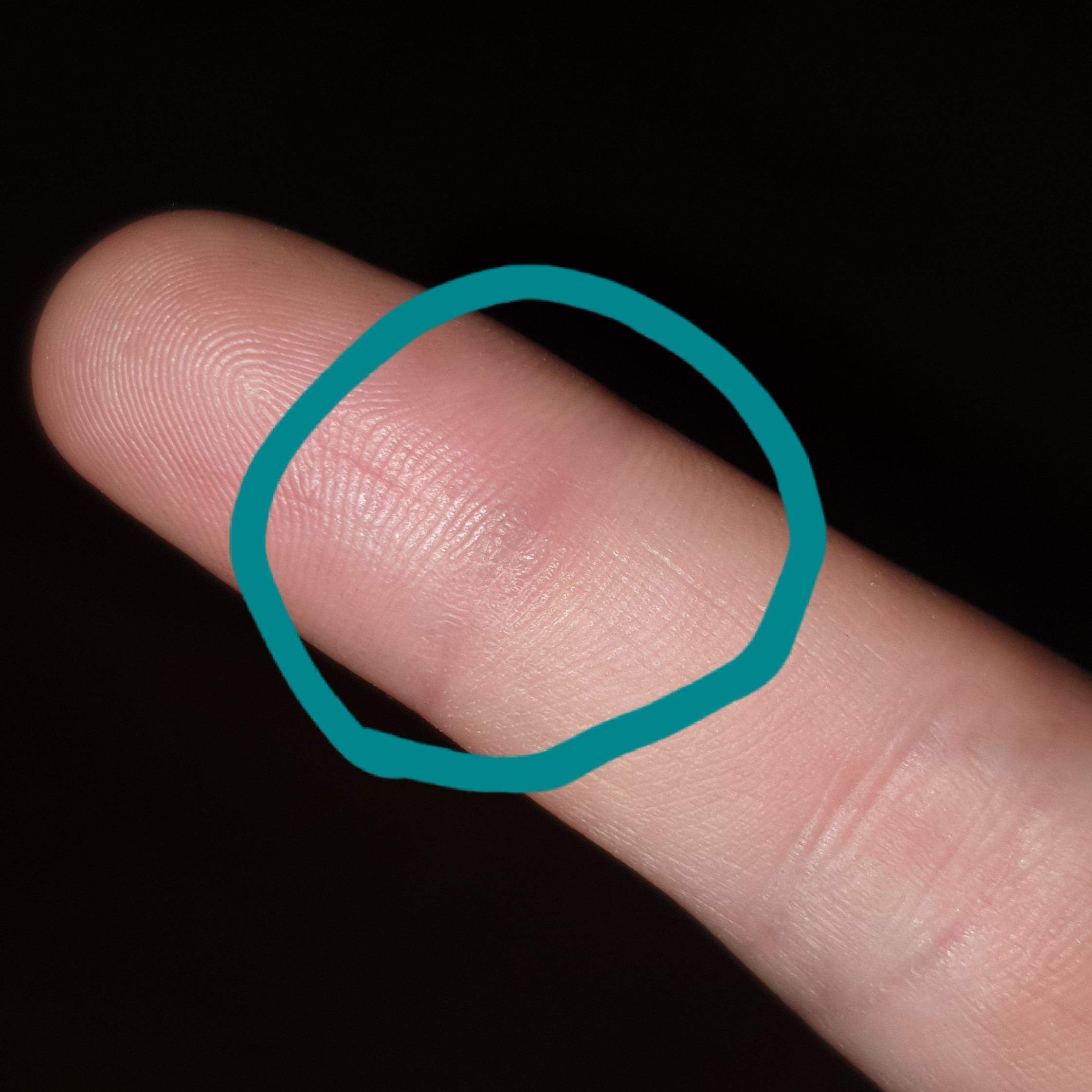 Bläulicher Punkt/Knubbel am Finger? (Haut, Sport, Blut) Bläulicher Punkt/Knubbel am Finger? (Haut, Sport, Blut)