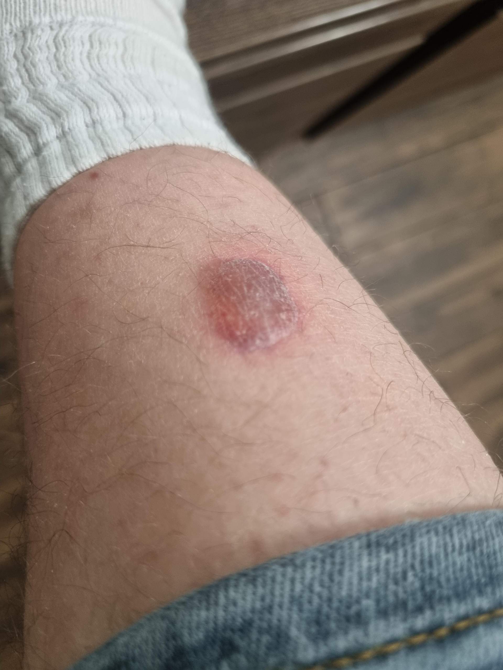 Blase am Schienbein? Was kann ich am besten tun? (Haut) Blase am Schienbein? Was kann ich am besten tun? (Haut)