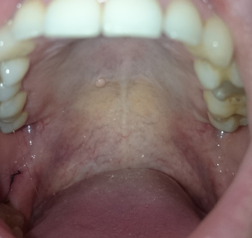 Blase Im Gaumen Blase Im Gaumen