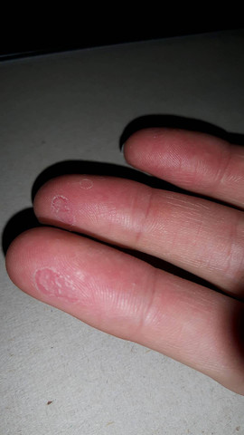 Blasen An Den Fingern Die Nicht Mehr Weggehen Finger Blasen An Den Fingern Die Nicht Mehr Weggehen Finger