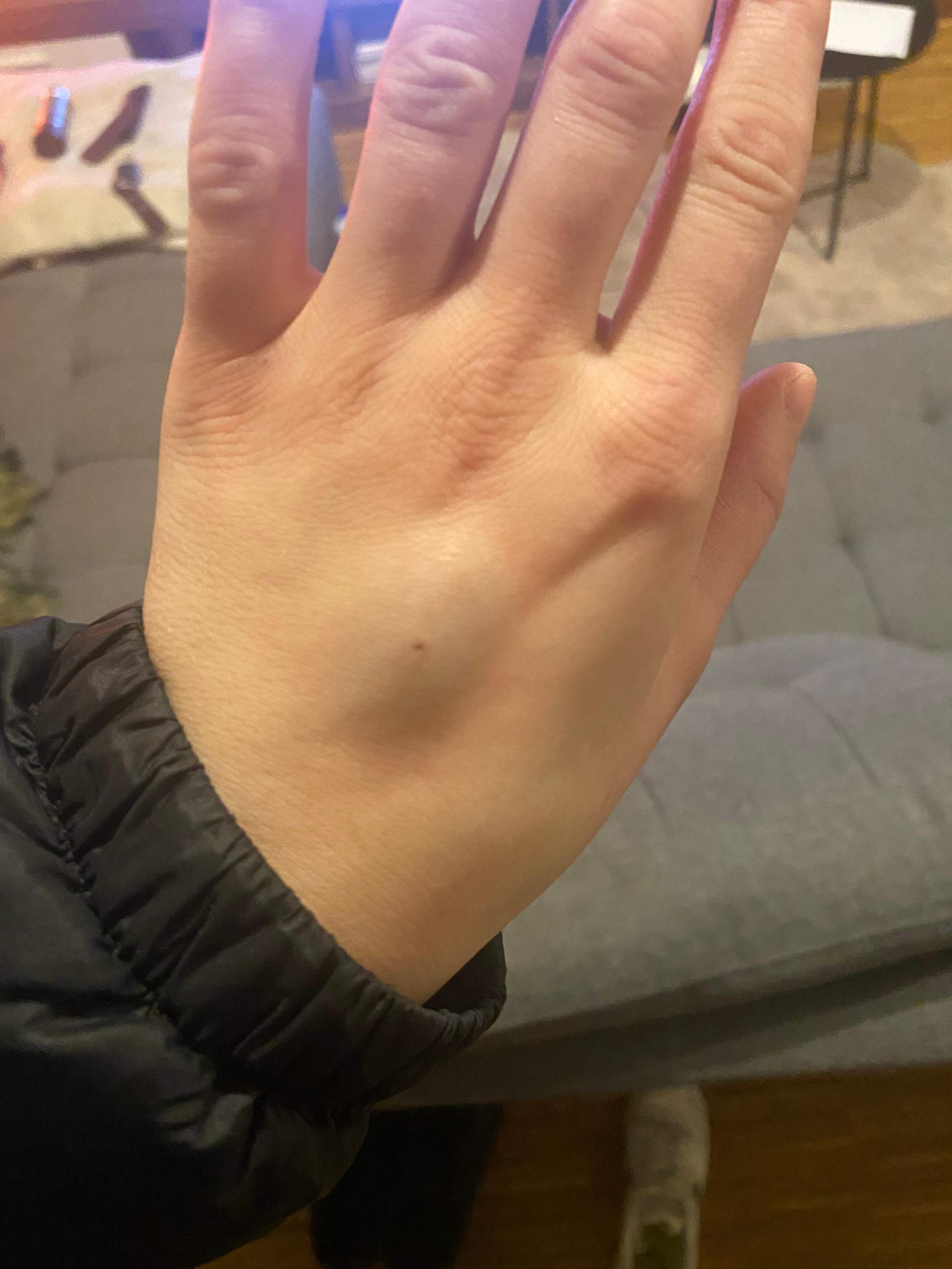 Blaue Beule nach Entfernung von Kanüle am Handrücken? (Venen, Blauer Fleck)