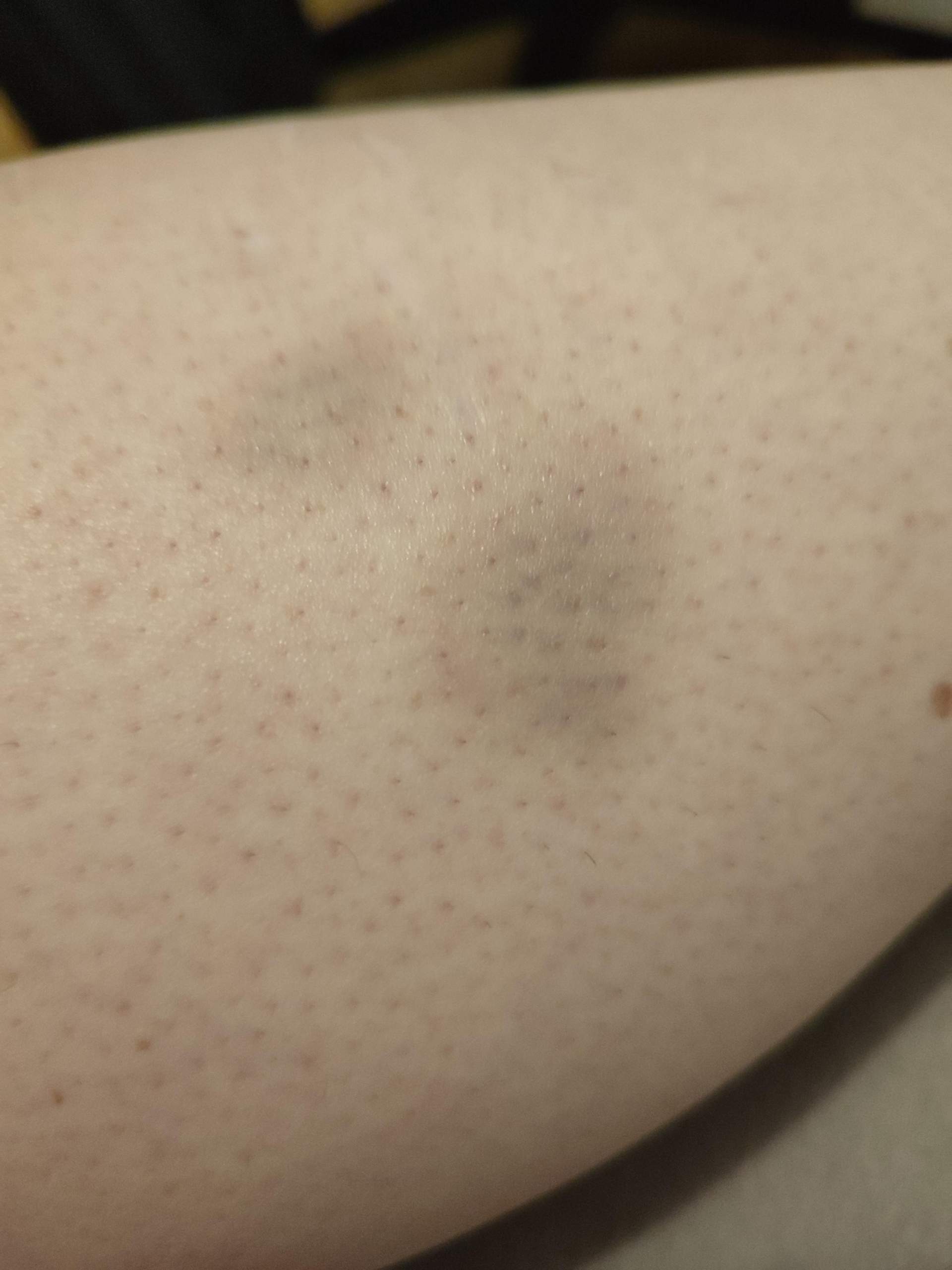Blaue Flecken Am Oberschenkel Ohne Grund