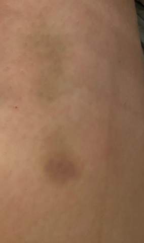 Blaue Flecken ohne Grund, Symptom für Leukämie?